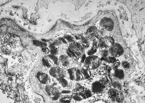 M, 17y. | Fabry disease - skin M, 17y. | Fabry disease - skin